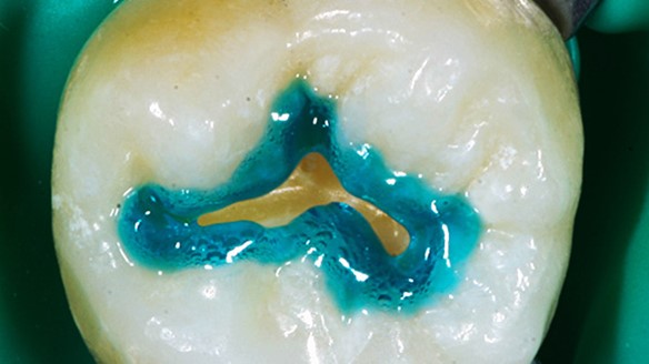 Gel Condicionador de Dentes