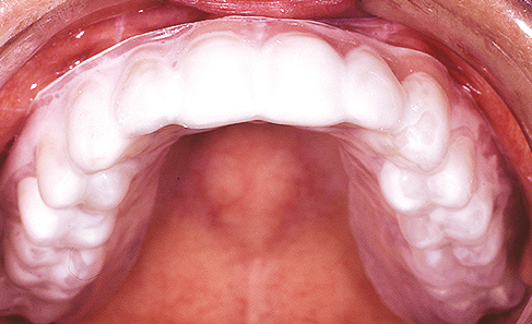 Aparelho de correção dentária de uma peça