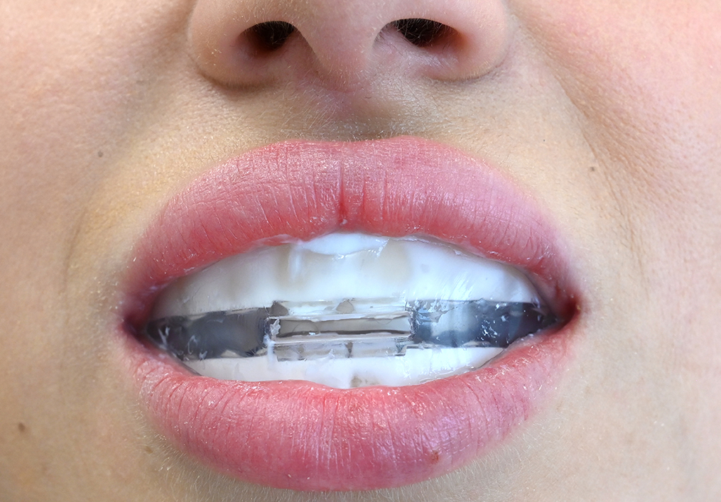 Conjunto de Remineralização e MIH (dentes de giz)